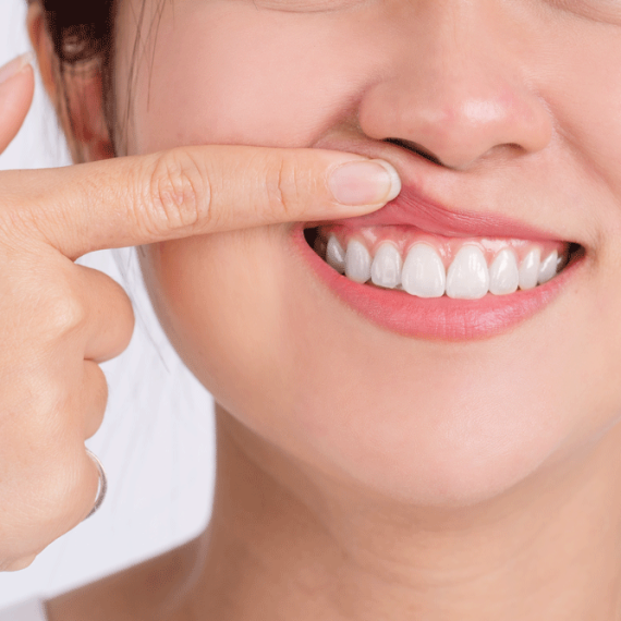 Gum Grafts