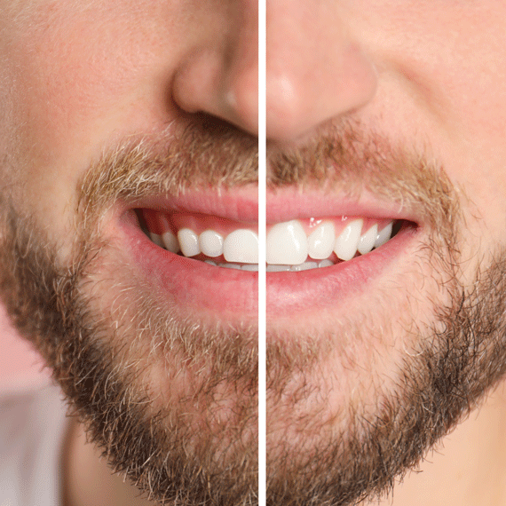 Before-and-after view of a smile with gum contouring